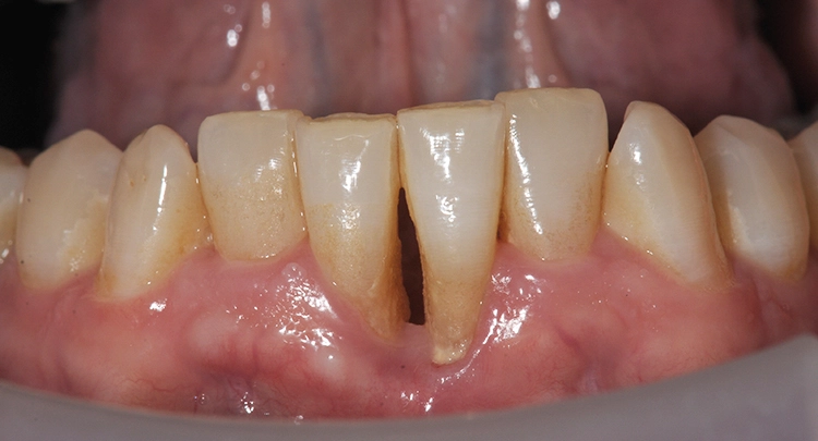 Abb. 1–4: Ausgangssituation: parodontaler Defekt mesial an 31/41.