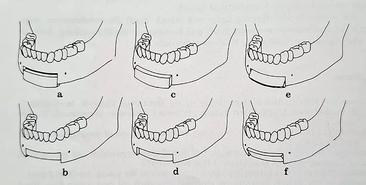 Abb. 1: Schubladenosteotomie (schematisch) nach Lindorf aus der Originalpublikation [6]. (a) Verlängerung der Kinnhöhe, (b) Verkürzung der Kinnhöhe,
(c) Augmentation der Kinnprominenz, (d) Reduktion der Kinnprominenz,
(e) Schwenkung nach vorn, (f) Schwenkung nach hinten.