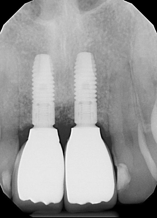 Abb. 1: Radiologischer Ausgangsbefund der implantatprothetischen Versorgung der Zähne 11 und 21 vor den approximal-zervikalen Anbauten.