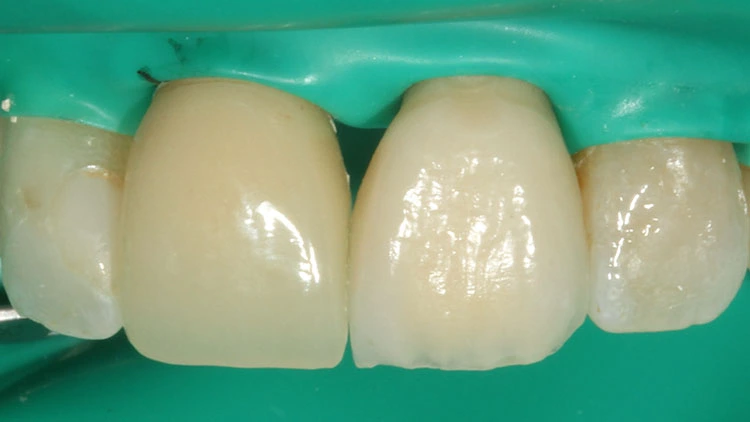 Abb. 1: Isolierung des Frontzahnsegmentes von Zahn 14–24 zur basalen Verbreiterung der Implantatkrone 21. Zahn 11 trägt ein PMMA-LZP.