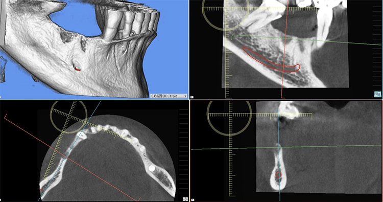 Abb. 1: Die DVT-Aufnahme macht das Gesamtausmaß des Knochendefizites deutlich.
