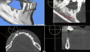 Die DVT-Aufnahme macht das Gesamtausmaß des Knochendefizites deutlich.