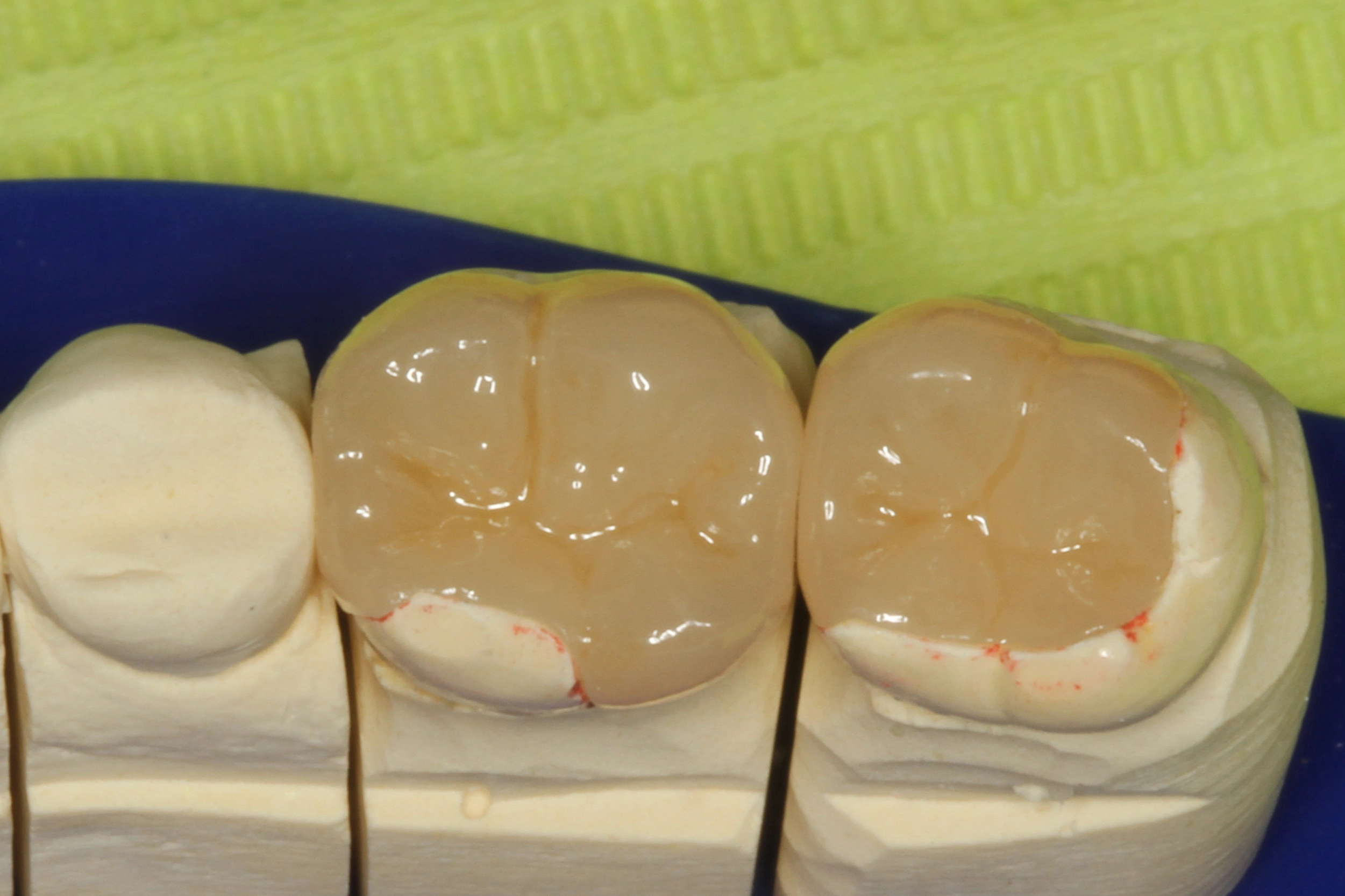 Abb. 1: IPS e.max Press-Teilkronen für die Zähne 46 und 47 auf dem Labormodell.