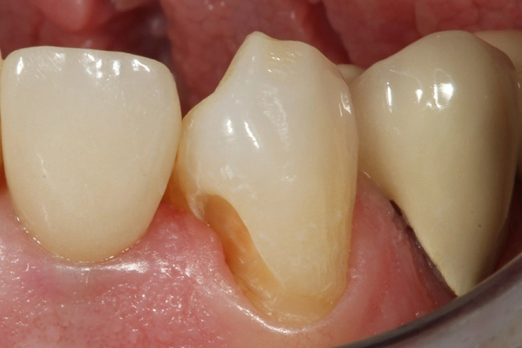 Abb. 1: Nach mesial extendierte Zervikalläsion als Folge einer insuffizienten Klasse-V-Füllung mit nach mesial reichender Sekundärkaries.