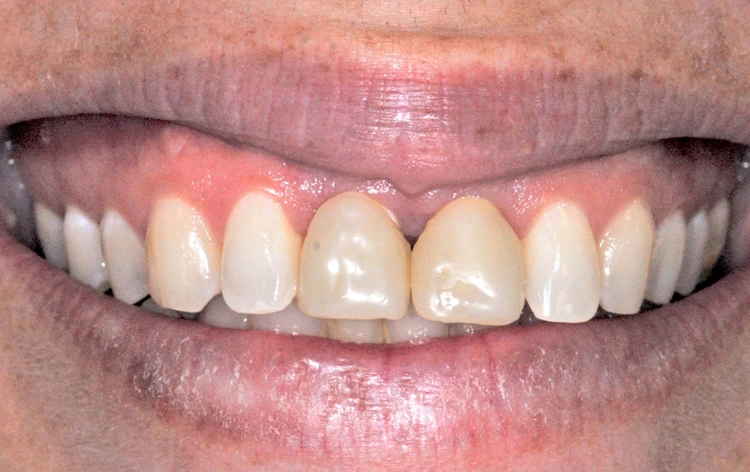 Abb. 1: Klinische Ausgangssituation mit geschwollener keratinisierter Gingiva und sulkulären Einblutungen labial in regio 11 und 21.