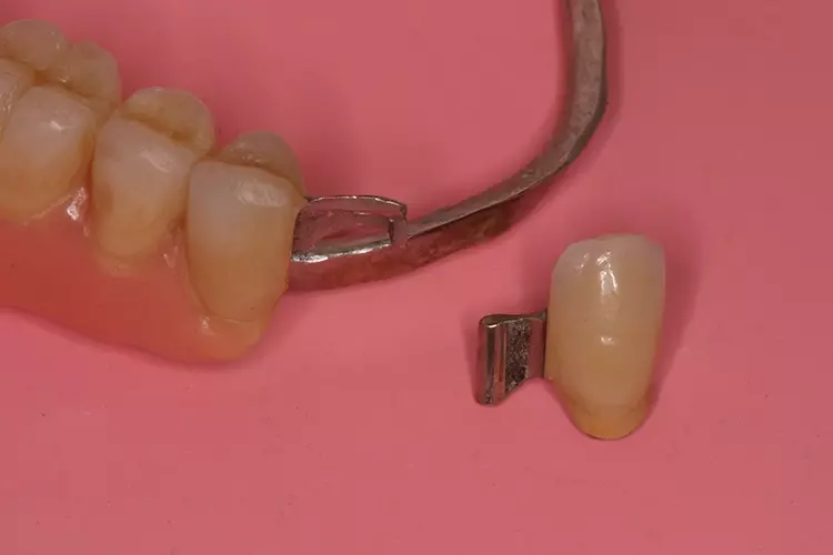 Abb. 1: Epigingival frakturierte konventionelle Geschiebekrone.