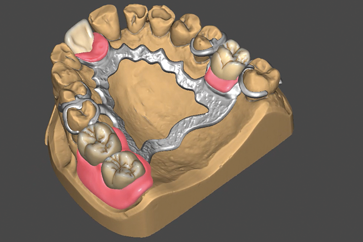 Abb. 1: Digitale Produktion der Gingiva und der Zähne in einem Schritt.
