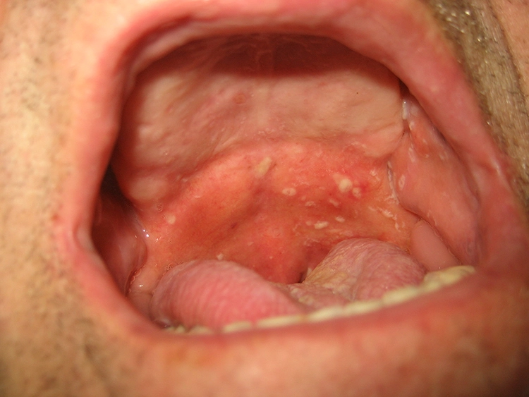 Abb. 1: HSV (Herpes-simplex-Virus) -Läsion an der Nase rechts im Krustenstadium: Typisch sind die polyzyklische Begrenzung der Läsion und die gelbe Verkrustung.