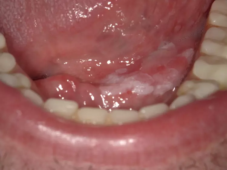 Abb. 1: Orale Leukoplakie des Mundbodens.