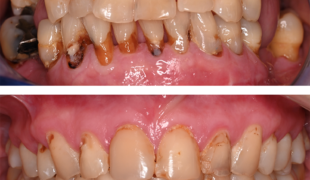 Abb. 1: Intraorale Situation bei ausgeprägter Hyposalivation bei
a) Sicca-Syndrom im Rahmen einer rheumatischen Erkrankung (CREST-Syndrom) und
b) Sjögren-Syndrom.