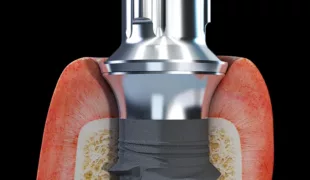 Abb. 1: Die neue Straumann-Entwicklung TLX ist eine Kombination des bewährten Tissue-Level-Implantats mit maschinierter Tulpe und BLX, was biologische Breite in die Vertikale bringt und das Weichgewebsmanagement optimal unterstützt.