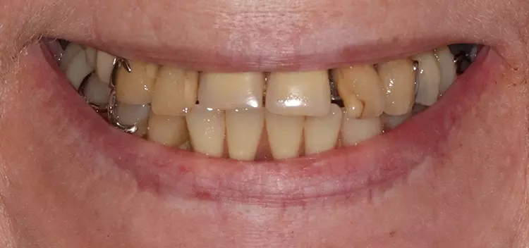 Abb. 1a: Ansicht vor Behandlungsbeginn – smile line.