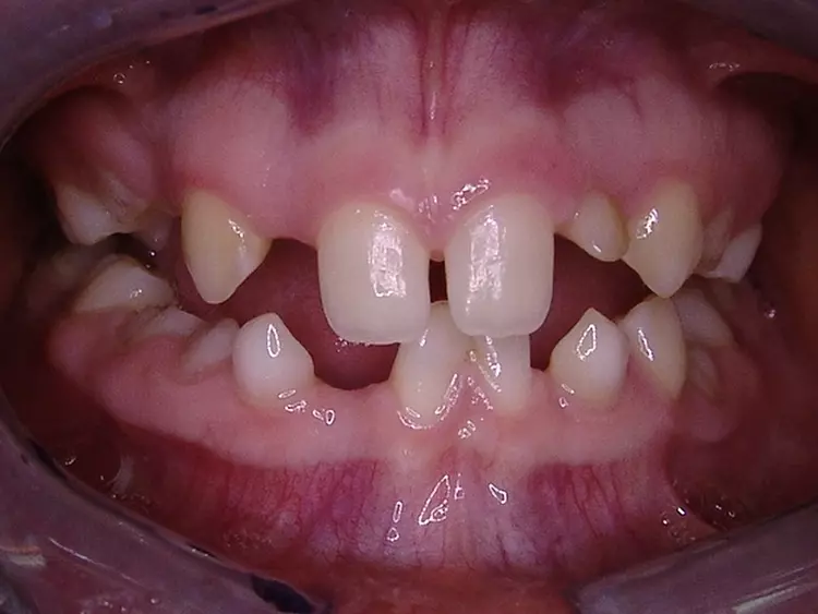 Abb. 1a: 16-jährige Patientin mit multipler Nichtanlage 2006