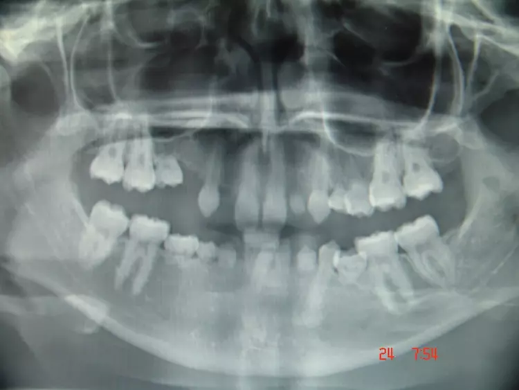 Abb. 1b: 16-jährige Patientin mit multipler Nichtanlage 2006.