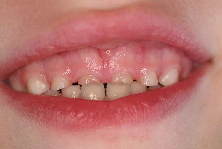 Abb. 1b: Verschiedene Befunde von Abrasionen bei Kindern in verschiedenen Altersgruppen.
Dieser Befund ist sehr häufig. Im Vergleich dazu sehr starke Abrasionen
bei den oberen Milchschneidezähnen bei einem 6-Jährigen (b).