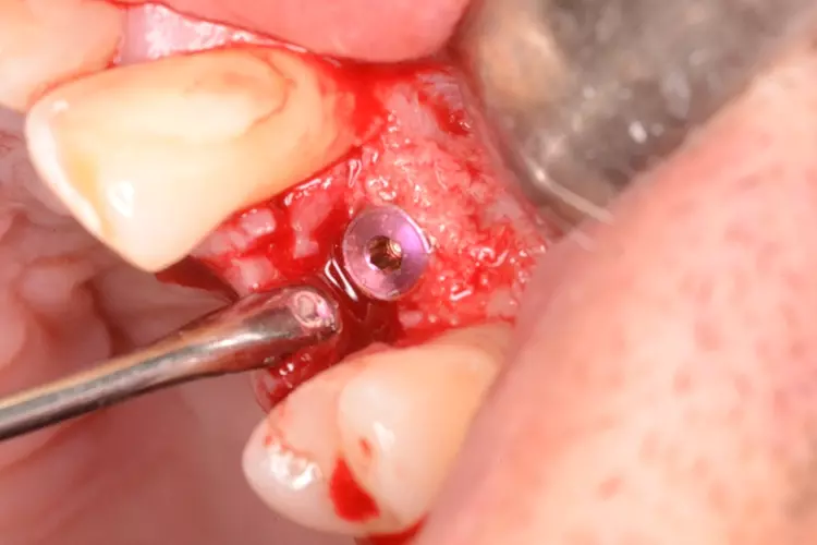 Abb. 1c: Implantat 24.