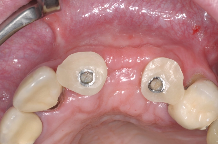 Abb. 16: Postoperative Kontrolle nach Einbringung individualisierter Gingivaformer.