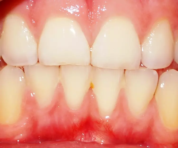 Abb. 1c: Verschiedene Befunde von Abrasionen bei Kindern in verschiedenen Altersgruppen.
Ein solcher Befund ist eher selten. Nun stehen diese Zähne auch kurz vor der physiologischen
Exfoliation, da im Unterkiefer bereits die permanenten Zähne durchbrechen, und bedürfen wohl keiner weiteren Therapie. Abrasionen an den Frontzähnen bei einem
Jugendlichen (c), der anamnestisch angibt, bei der Bearbeitung der Hausaufgaben und beim Lernen am Schreibtisch häufig mit den vorderen Schneidezähnen zu
knirschen.