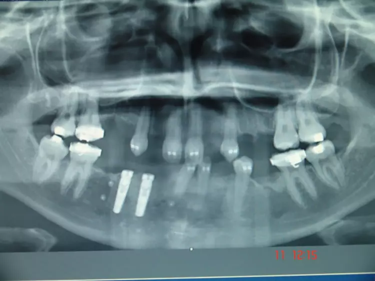 Abb. 1d: 1. Implantation UK 2006.
