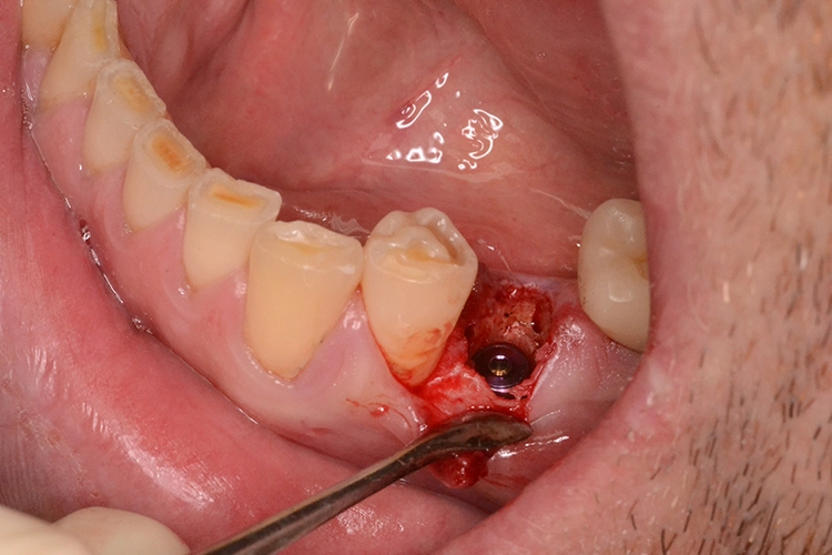 Abb. 1d: Implantation.