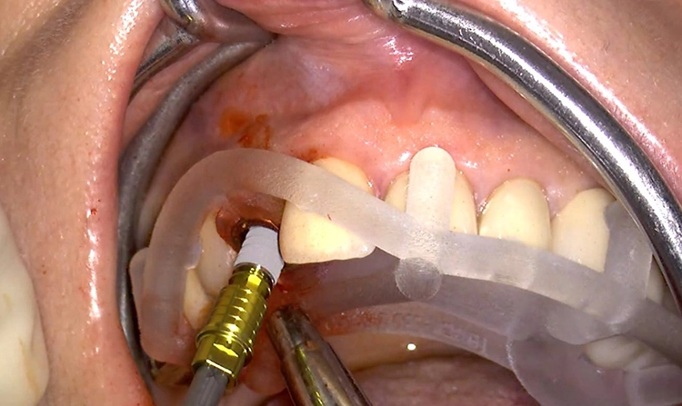 Abb. 18: Ventrale und crestale Ansicht auf die eingesetzte Bohrschablone und geführte Implantation in regio 12.