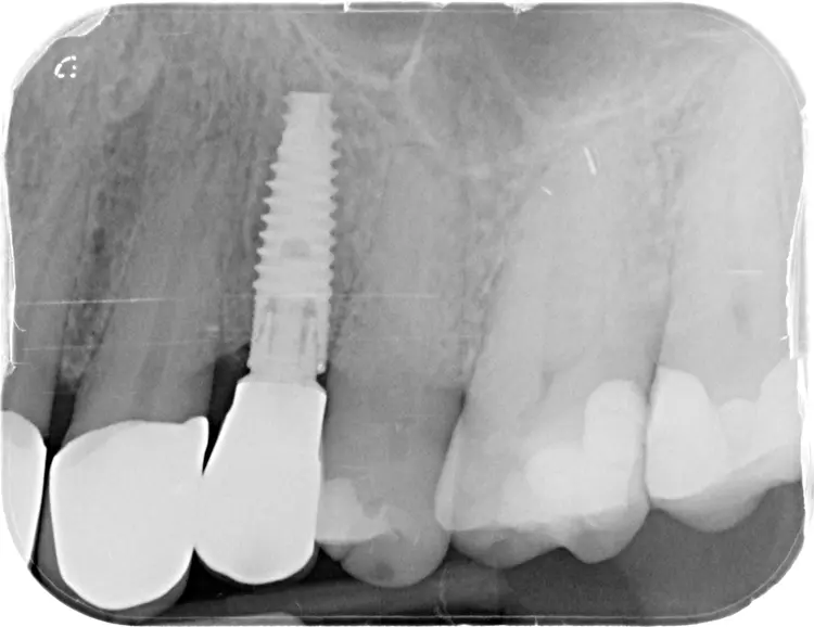 Abb. 1i: Röntgenkontrolle des Implantats.