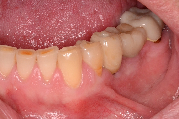 1i: Eingegliederte Implantatkrone, PGZ – Peter-Gängler-Zahntechnik.