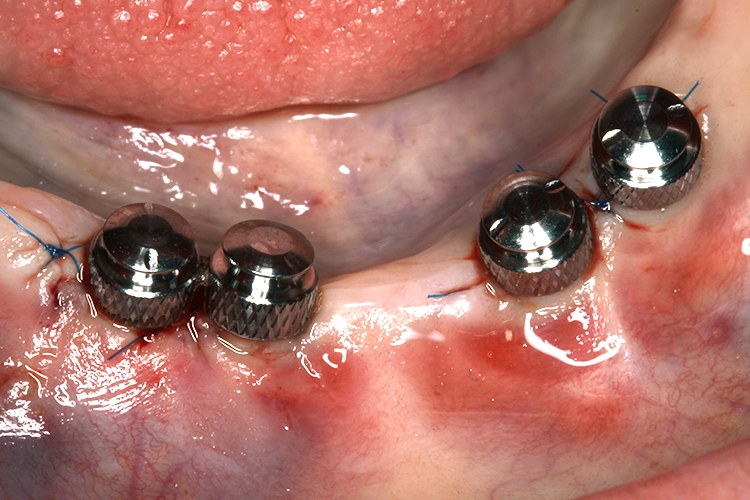 Abb. 2: Metal-Housings auf 4 MDI-Implantaten.