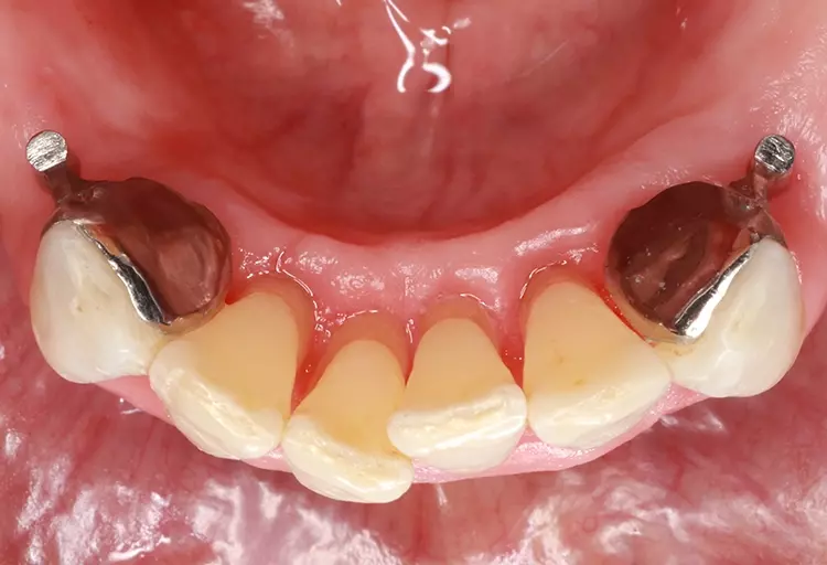 Abb. 20: Eingegliederte Adhäsivattachments 33
und 43 (Okklusalansicht).