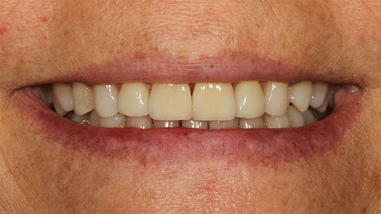 Abb. 20: Lippenbild nach Einsetzen der Veneers.