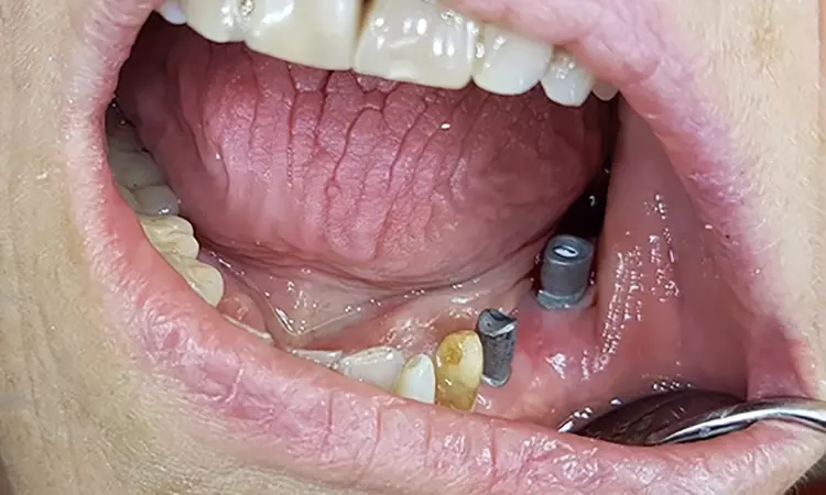 Abb. 20: Finale Versorgung mit Einzelkronen auf Zahn 33 und 34 sowie einer Implantatbrücke von 35 bis 37 in stabil ausgeformter periimplantärer Weichgewebemanschette.
