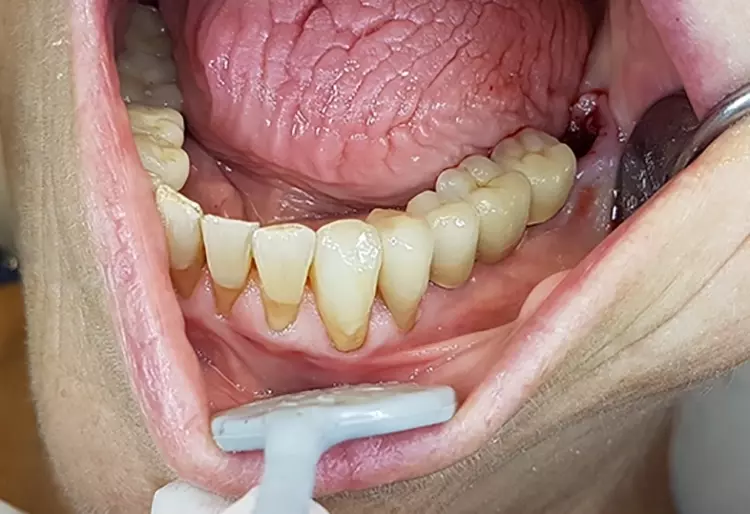 Abb. 21: Finale Versorgung mit Einzelkronen auf Zahn 33 und 34 sowie einer Implantatbrücke von 35 bis 37 in stabil ausgeformter periimplantärer Weichgewebemanschette.