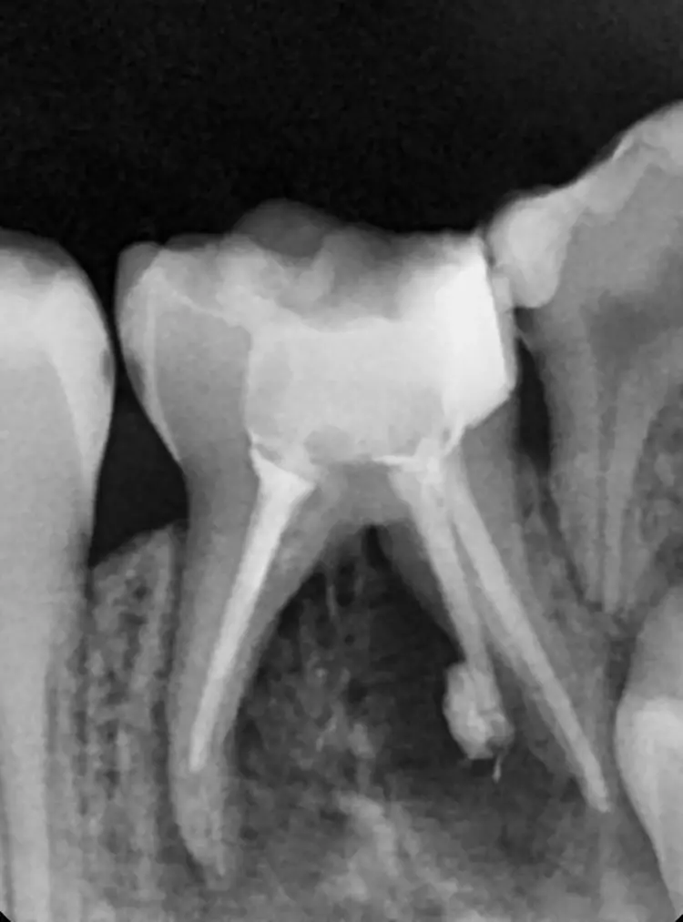 Abb. 21: Wurzelfüllung mit biokeramischem
Sealer Sure-Seal Root
(Sure Dent, Südkorea) und Guttaperchastiften.