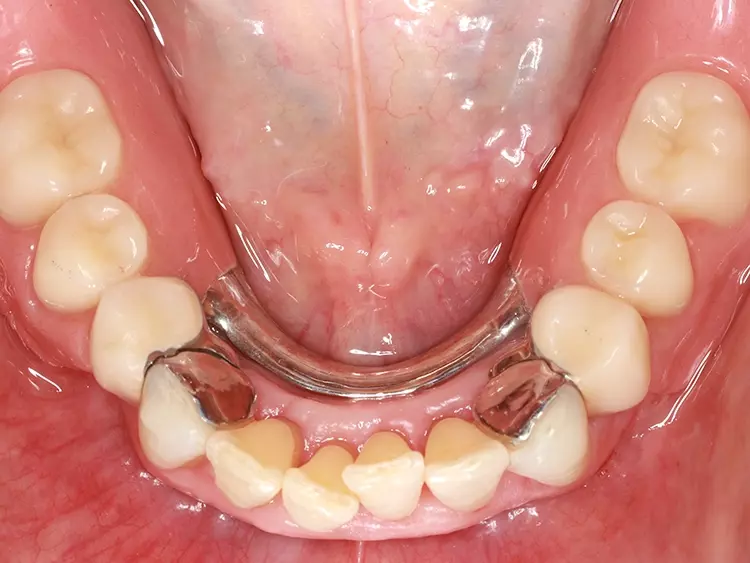 Abb. 21: Eingegliederte Teilprothese mit Adhäsivattachments
an 33 und 43 als Retentionselemente
(Okklusalansicht).