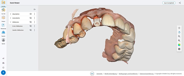 Abb. 21a: Festlegung der finalen Implantatposition durch intraoralen 3D-Scan.