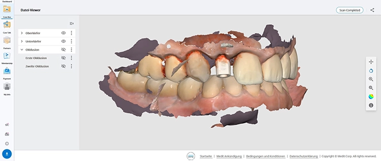 Abb. 21b: Festlegung der finalen Implantatposition durch intraoralen 3D-Scan.