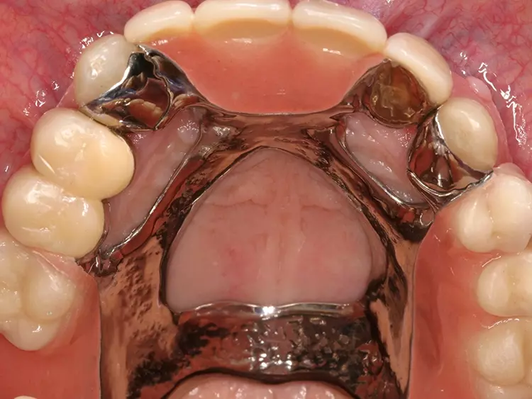 Abb. 22: Eingegliederte Teilprothese mit Adhäsivattachments
an 13 und 23, kombiniert mit Doppelkronen
an den Zähnen 15, 14 und 22 als Retentionselemente
(Okklusalansicht).
