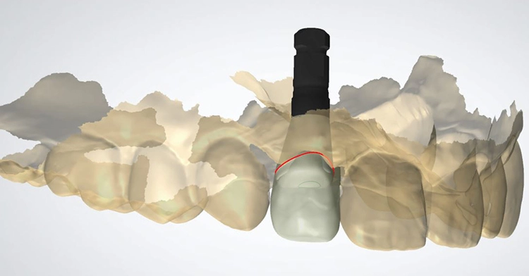 Abb. 22 a: Verschiedene Ansichten auf die geplante Versorgung: a) bukkale Ansicht. Das Durchtrittsprofil des Gingivaformers wird auf eine virtuelle Krone gematcht und entsprechend gestaltet (3Shape CAD Software®, Kopenhagen, Dänemark).