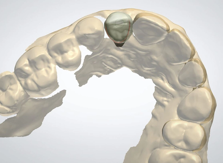 Abb. 22 b: Verschiedene Ansichten auf die geplante Versorgung: b) vertikale Ansicht. Das Durchtrittsprofil des Gingivaformers wird auf eine virtuelle Krone gematcht und entsprechend gestaltet (3Shape CAD Software®, Kopenhagen, Dänemark).