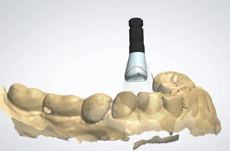 Abb. 22 c: Verschiedene Ansichten auf die geplante Versorgung: c) Oberkiefer heraussegmentiert. Das Durchtrittsprofil des Gingivaformers wird auf eine virtuelle Krone gematcht und entsprechend gestaltet (3Shape CAD Software®, Kopenhagen, Dänemark).