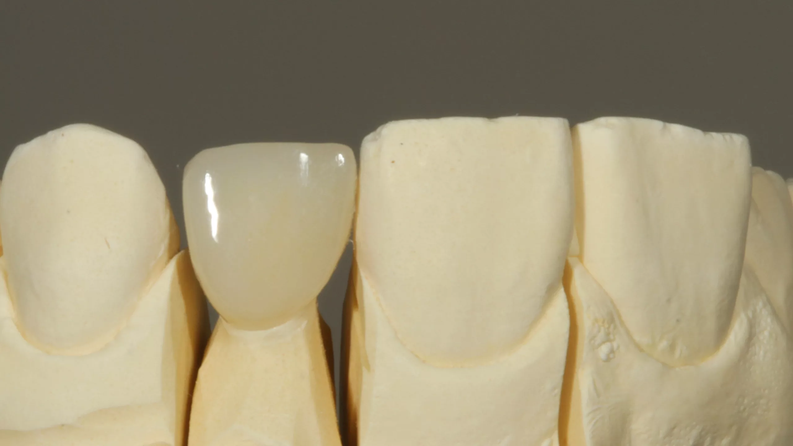 Abb. 13: Labial verblendete, monolithische Vollzirkonkrone. Ansicht auf dem Labormodell von labial.