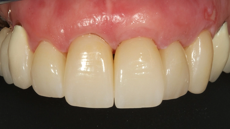 Abb. 22: Finale Detailaufnahme der Oberkieferfrontzähne 4 Wochen nach der adhäsiven Befestigung der Vollzirkonteilkronen und Veneers.