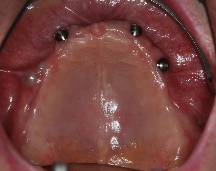 Abb. 23: Implantation mit abgeflachtem Vestibulum vom 1.12.2015.