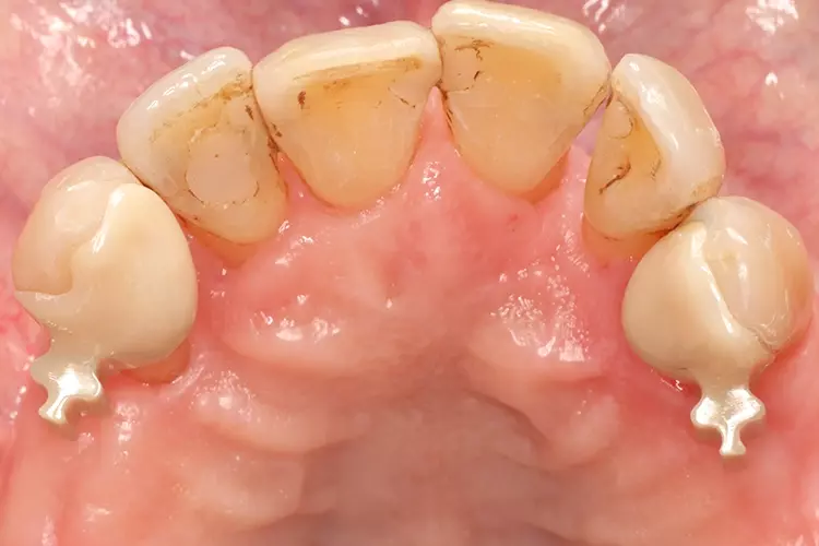 Abb. 23: Eingegliederte Adhäsivattachments 13
und 23 aus monolithischer 3Y-TZP-Zirkonoxidkeramik
(Okklusalansicht).