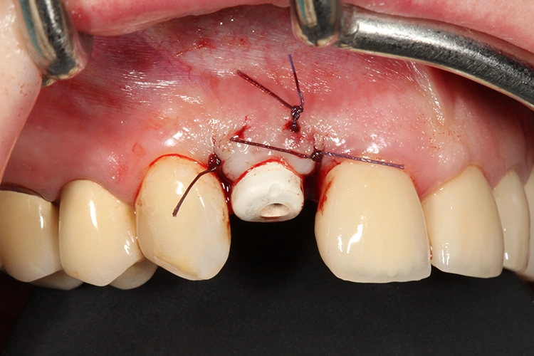 Abb. 25: Eingesetzter individueller Gingivaformer und Fixation der periimplantären Mukosa.