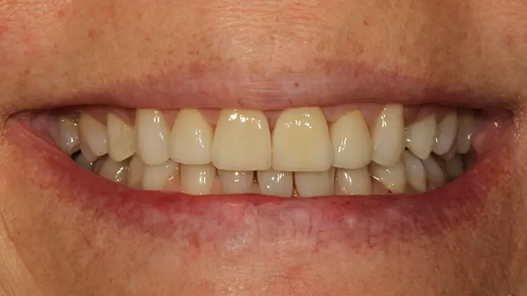Abb. 24: Lippenbild bei der Kontrolle 1 Jahr nach Einsetzen der Veneers.