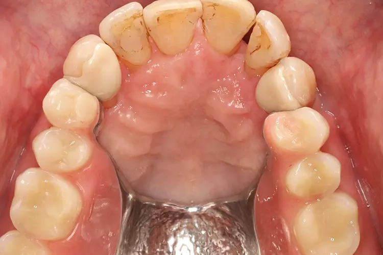 Abb. 24: Eingegliederte Teilprothese mit
Adhäsivattachments an 13 und 23 aus monolithischer
3Y-TZP-Zirkonoxidkeramik (Okklusalansicht).