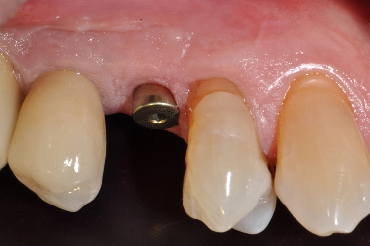 Abb. 13: Xive-PS-Gingivaformer der neuesten Generation. Die konkave Geometrie unterstützt den Erhalt des krestalen Knochens sowie zugleich eine ideale Adaption der Weichgewebe als trichterförmiges Emergenzprofil.