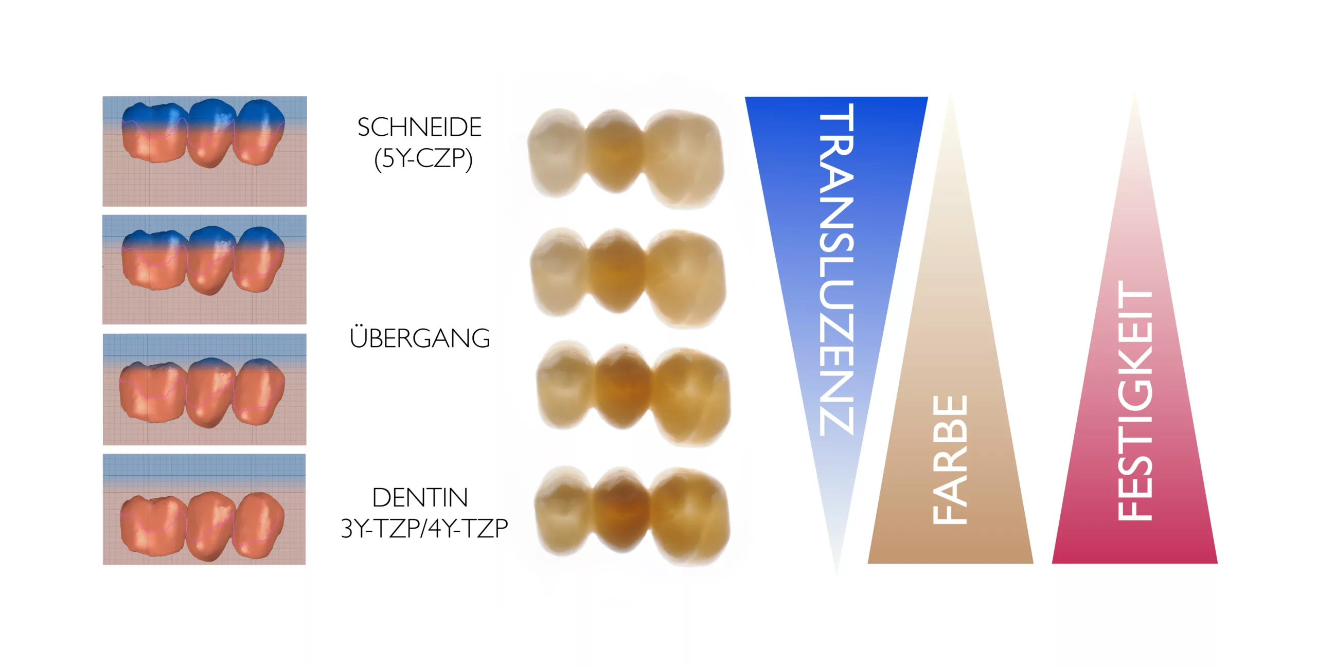 Abb. 25: Die Gradienten-Technologie ist die aktuellste Entwicklung im Bereich der Zirkoniumdioxide. Die Rohlinge weisen dabei sowohl einen Farb- und Transluzenz- als auch einen Materialgradienten auf.