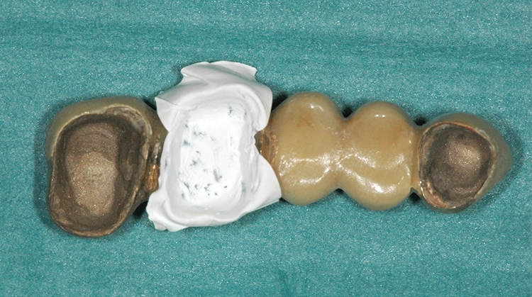 Abb. 26: Auskleidung des Kronenlumens 26 mit Teflonband als Isolationsschicht.